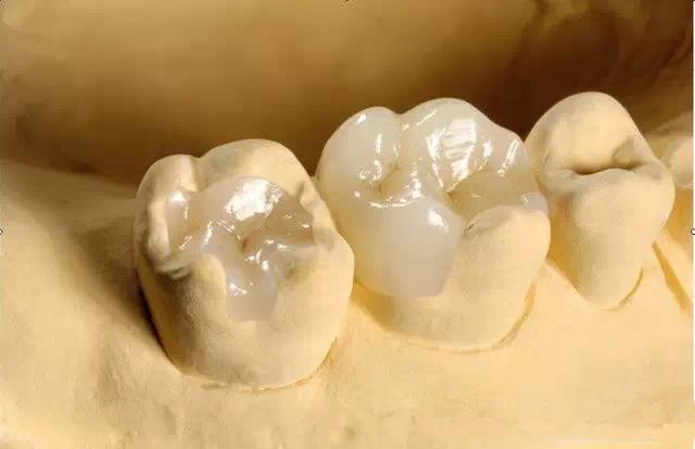 China dental lab Porcelain Fused to Metal crown